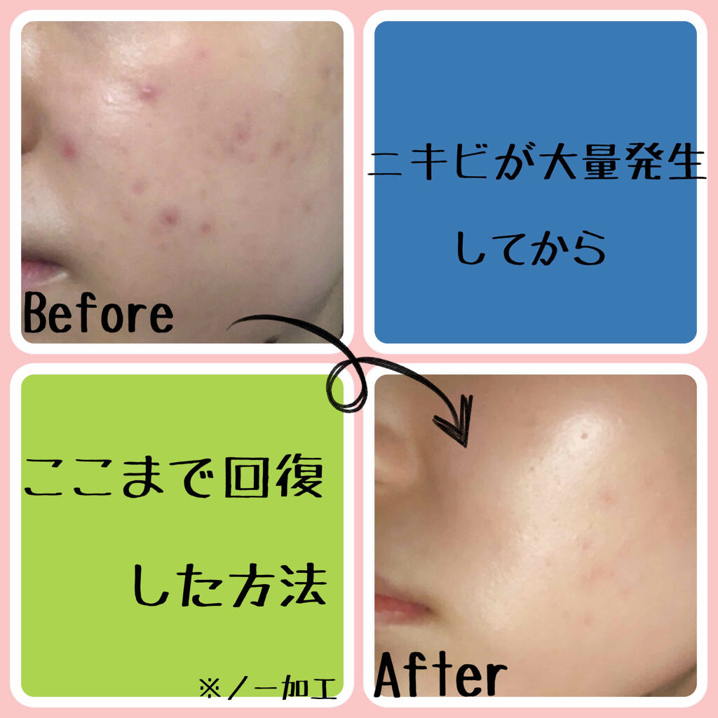 ティーツリーケアソリューション アンプルマスクJEX/MEDIHEAL/シートマスク・パックを使ったクチコミ（1枚目）