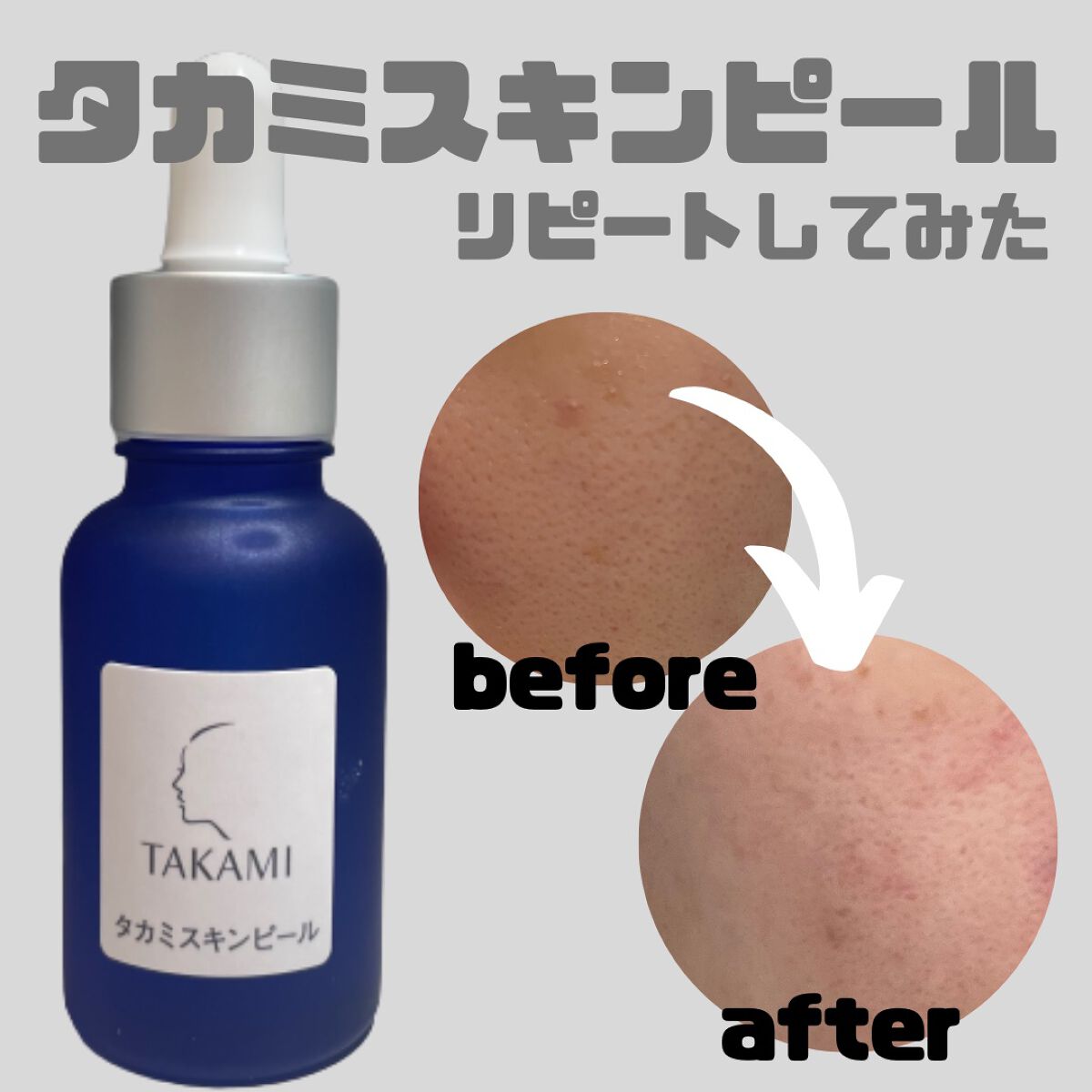 タカミスキンピール/タカミ/ブースター・導入液を使ったクチコミ(1枚目)