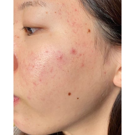 モイスチュア ローション/カルテHD/化粧水を使ったクチコミ(1枚目)