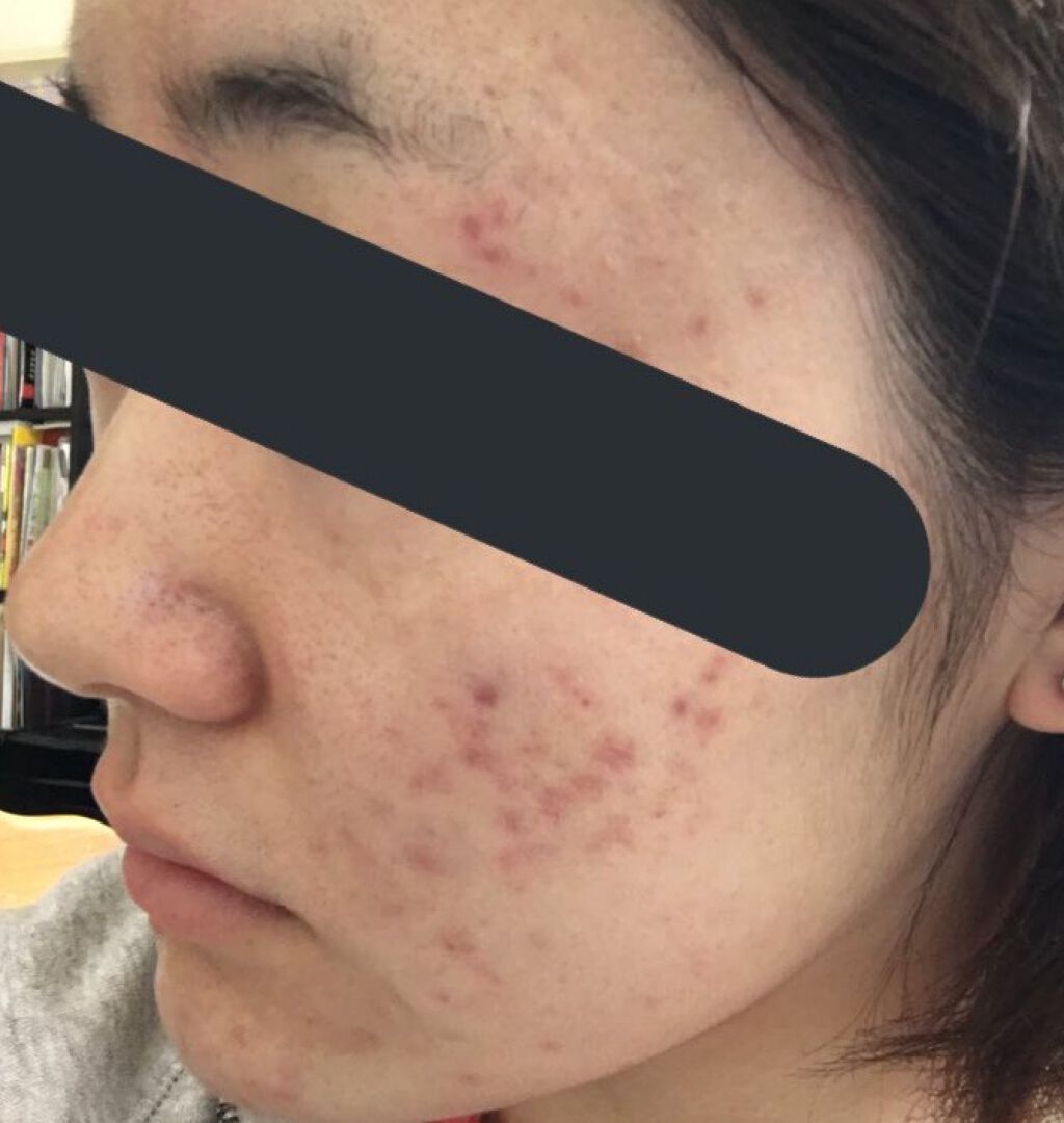 りんた on LIPS 「たくさん見ていただいて、ありがとうございます!私の肌の変化につ..」(2枚目)