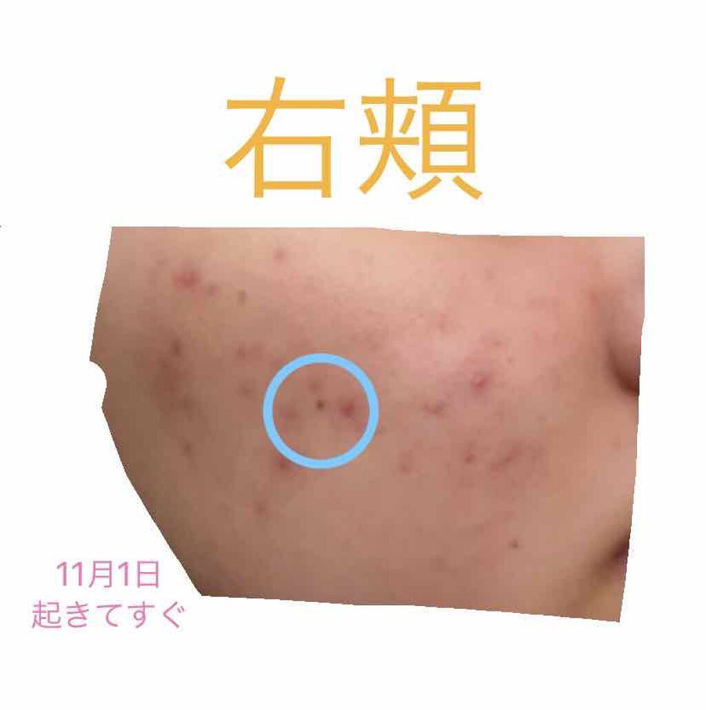 薬用しみ対策 美白化粧水/メラノCC/化粧水を使ったクチコミ（3枚目）