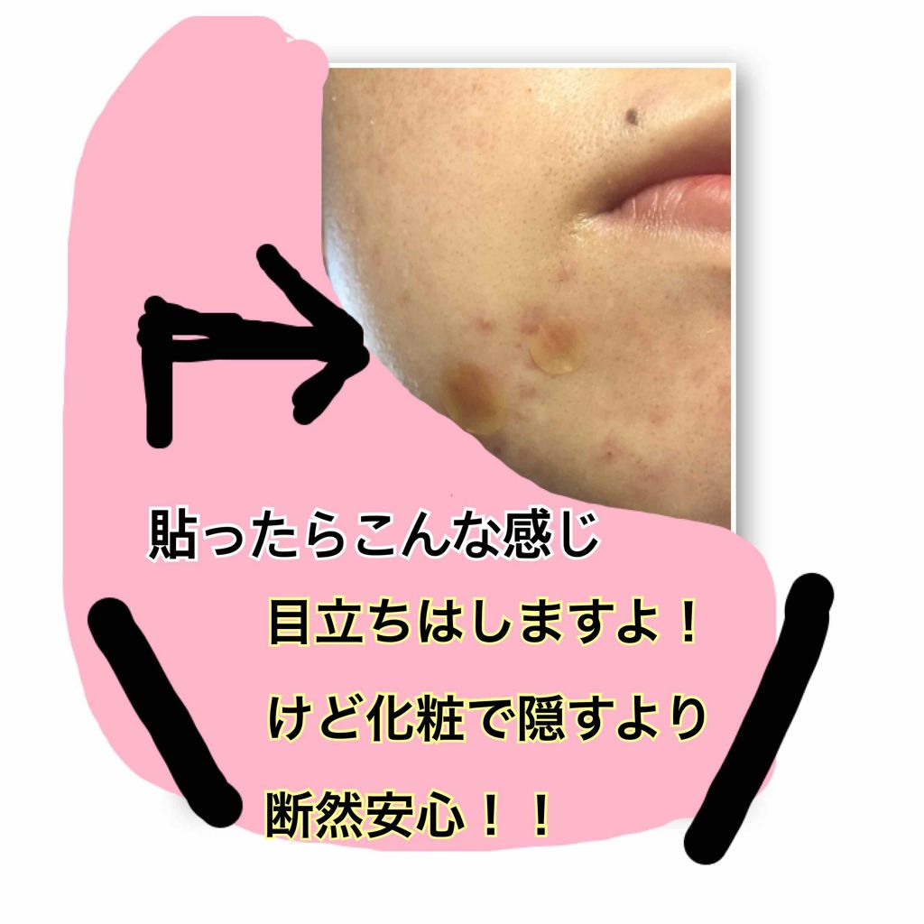 Nexcare/3M nexcare/にきびパッチを使ったクチコミ（3枚目）