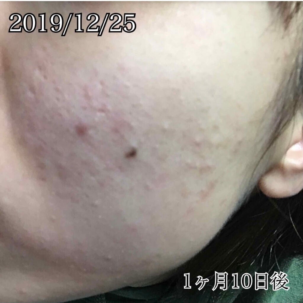 A アクネフォーム/NOV/洗顔フォームを使ったクチコミ(6枚目)