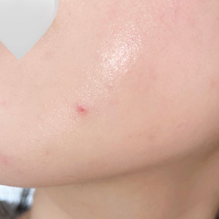 ペアアクネクリームW(医薬品)/ペア/その他を使ったクチコミ(1枚目)