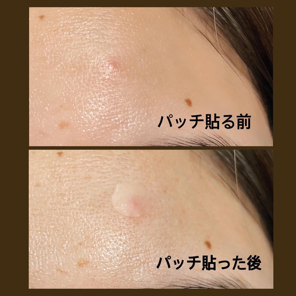 ティーツリーカーミングスポットパッチ/MEDIHEAL/その他スキンケアを使ったクチコミ(5枚目)