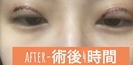 ãããœãð¡ãã©ãã100 on LIPS ãâïžäºéåéã¬ããããŠã³ã¿ã€ã ã1æ¥ç®â»beforeã®åçãè¡..ãïŒ4æç®ïŒ