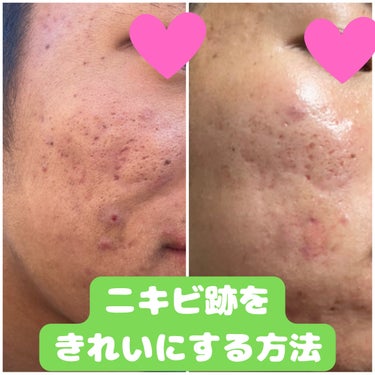 メラノCC 薬用しみ集中対策 プレミアム美容液のクチコミ「【脱ニキビ跡肌！〜スキンケア編〜】

今日は実際に弟の思春期ニキビ肌をここまできれいにした方法.....」（1枚目）