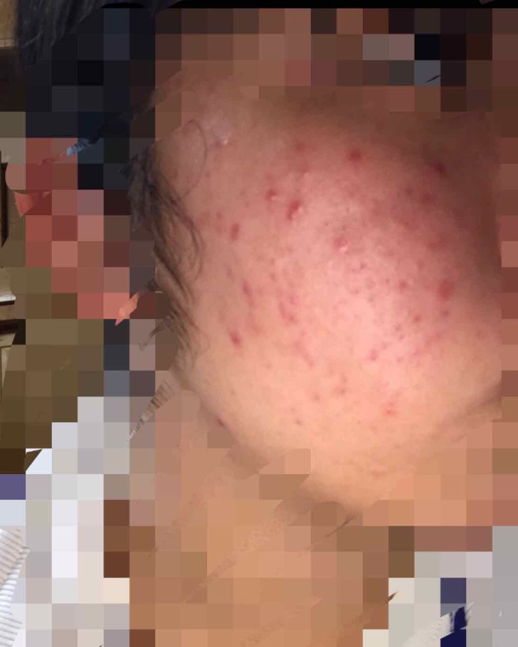 ま な か on LIPS 「ニキビについて悩み相談させてください!!閲覧注意です。にきびが..」(3枚目)