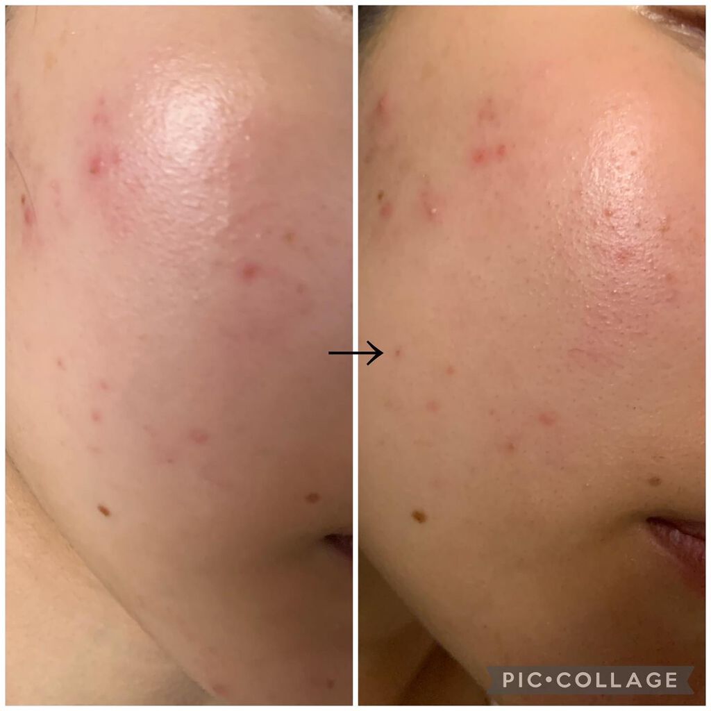 グリーンタンジェリン ビタC ダークスポットケアセラム/goodal/美容液を使ったクチコミ（2枚目）