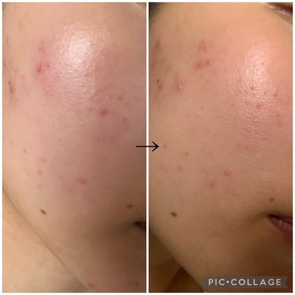 グリーンタンジェリン ビタC ダークスポットケアセラム/goodal/美容液を使ったクチコミ(2枚目)