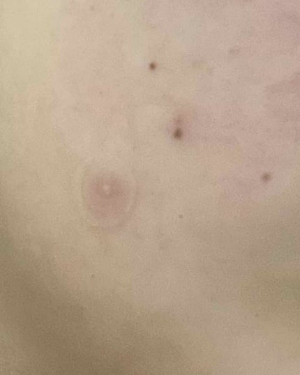 ゼロスポットパッチ/Today’s Cosme/にきびパッチを使ったクチコミ(4枚目)