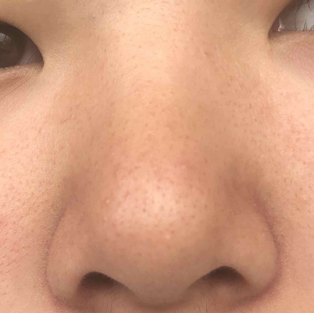 coral_cosme_66bp on LIPS 「中学2年の女子です。小学6年生の頃から鼻のブツブツに悩んでいた..」(3枚目)