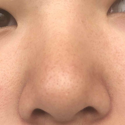 coral_cosme_66bp on LIPS 「中学2年の女子です。小学6年生の頃から鼻のブツブツに悩んでいた..」(3枚目)