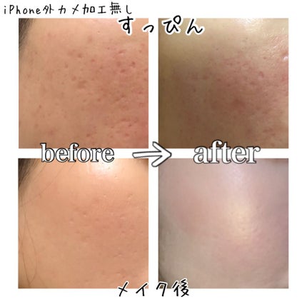 トリア・スキン エイジングケアレーザー/トリア/美顔器・マッサージを使ったクチコミ(1枚目)