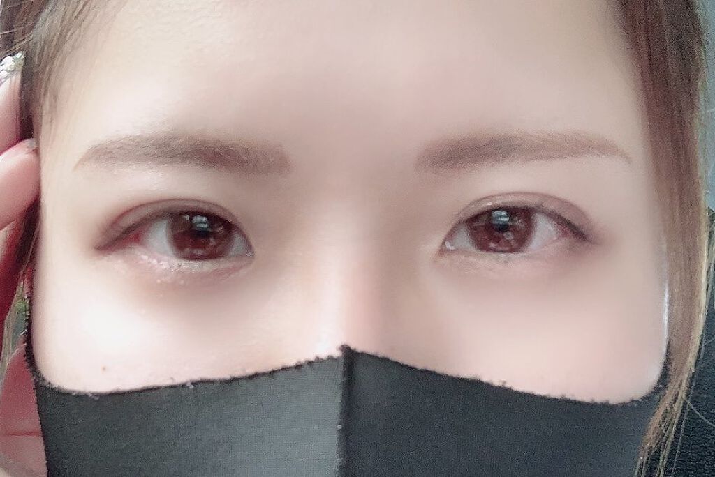 二重整形/その他を使ったクチコミ（1枚目）