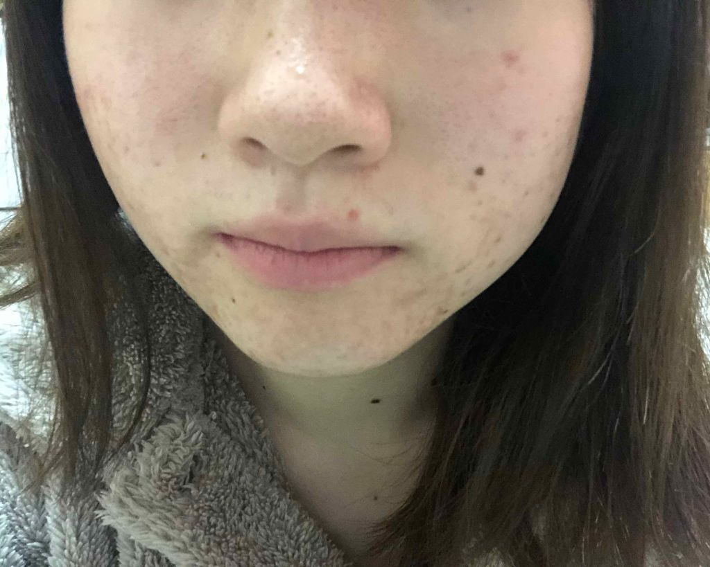 マンスリースキンケアプログラム(旧)/APEX/スキンケアキットを使ったクチコミ（2枚目）