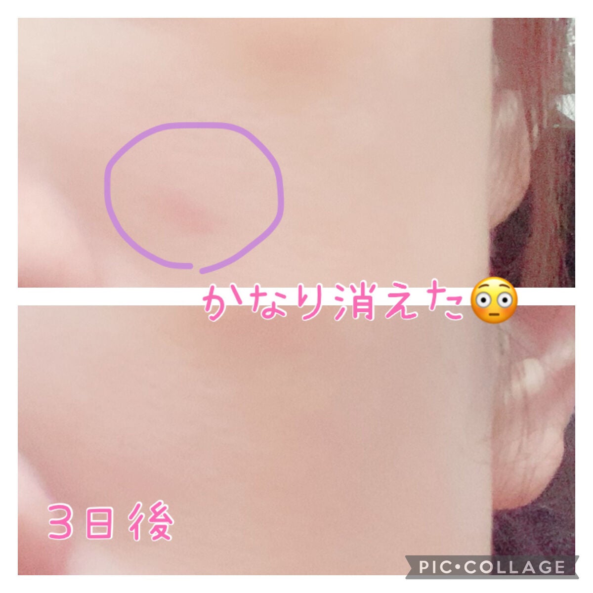 ニキビあとケアジェル/アットノン/その他スキンケアを使ったクチコミ(4枚目)