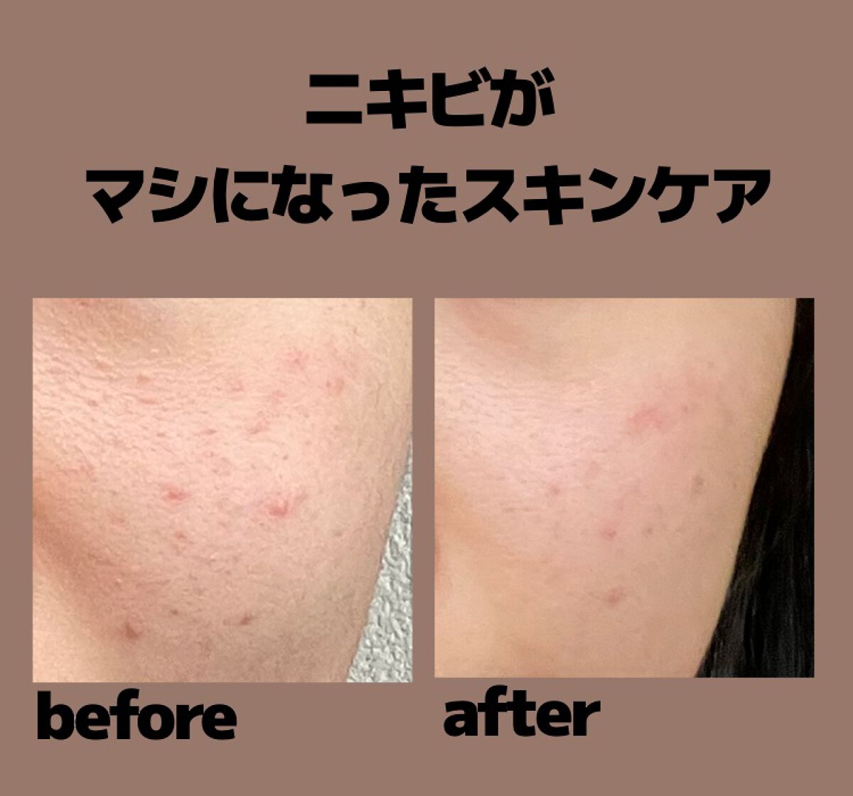 オードムーゲ 薬用ローション（ふきとり化粧水）/オードムーゲ/拭き取り化粧水を使ったクチコミ（1枚目）