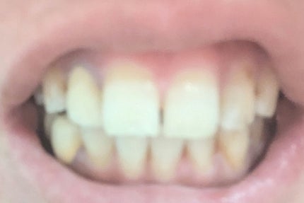 アパガードセレナ/アパガード/歯磨き粉を使ったクチコミ(2枚目)