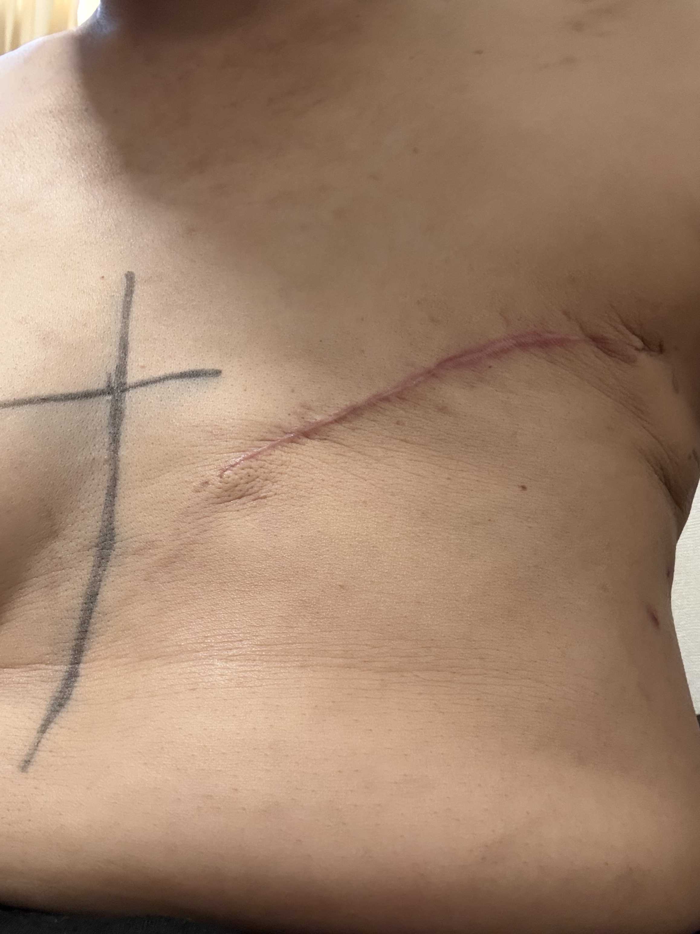 ビオレu ビオレu ザ ボディ 泡タイプ ディープクリアのクチコミ「がんサバイバーの通院日記

来月から11月上旬まで放射線治療スタート

放射線治療に欠かせない.....」（1枚目）