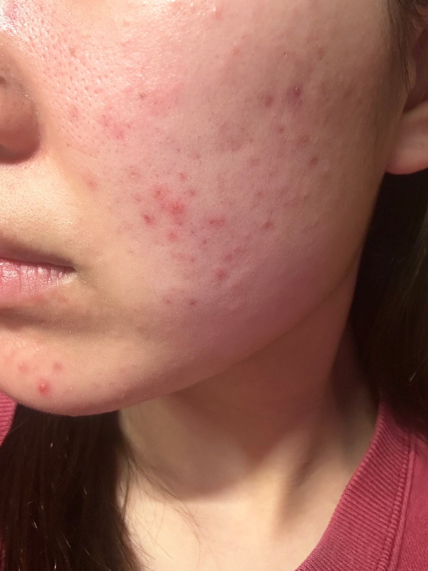 あ on LIPS 「ケミカルピーリング5回終了ケミカルピーリング初めてから赤ニキビ..」(2枚目)