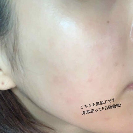 薬用顔ローション/ヘパソフト/化粧水を使ったクチコミ(3枚目)