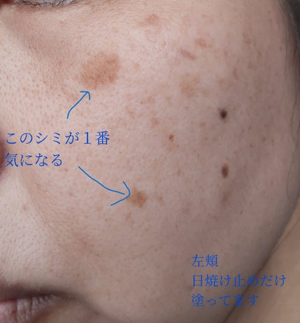 コンパス on LIPS 「こんにちは、コンパスです。今日は、シミ治療を始めたので、自分的..」(5枚目)