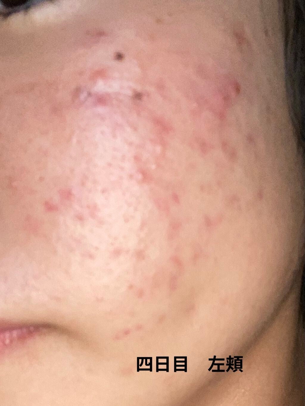 じぇーけー on LIPS 「私は中学2年生の始め頃からニキビが増え始めて、気になって潰した..」(9枚目)