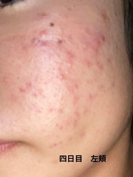 じぇーけー on LIPS 「私は中学2年生の始め頃からニキビが増え始めて、気になって潰した..」(9枚目)
