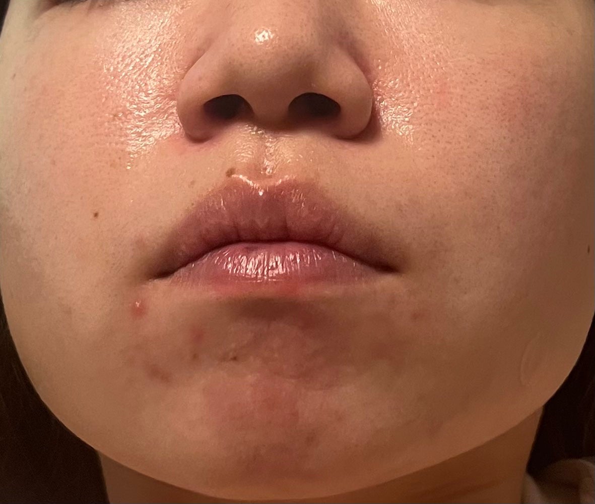 A アクネフォーム/NOV/洗顔フォームを使ったクチコミ(2枚目)