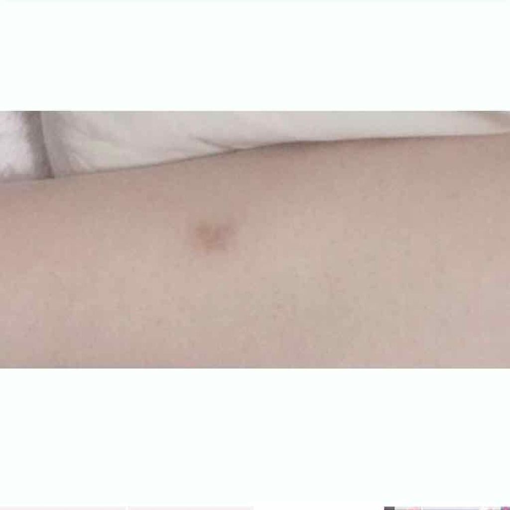 バイオイル/バイオイル/フェイスオイルを使ったクチコミ（3枚目）