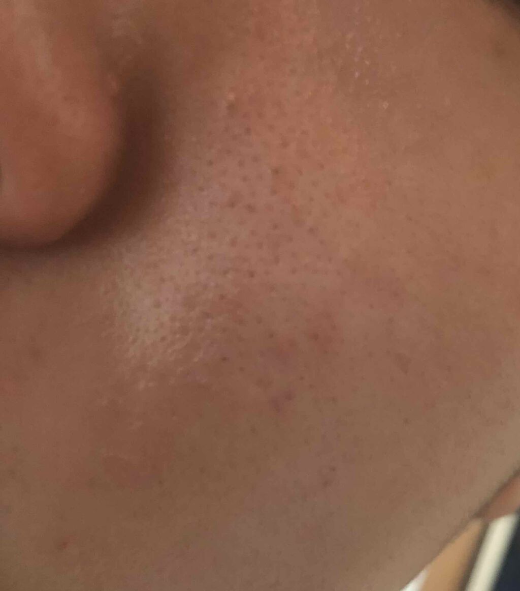 shiny_cosme_iu0 on LIPS 「助けてください頬の毛穴が酷くて悩んでいます、頬の毛穴に効くと言..」(2枚目)