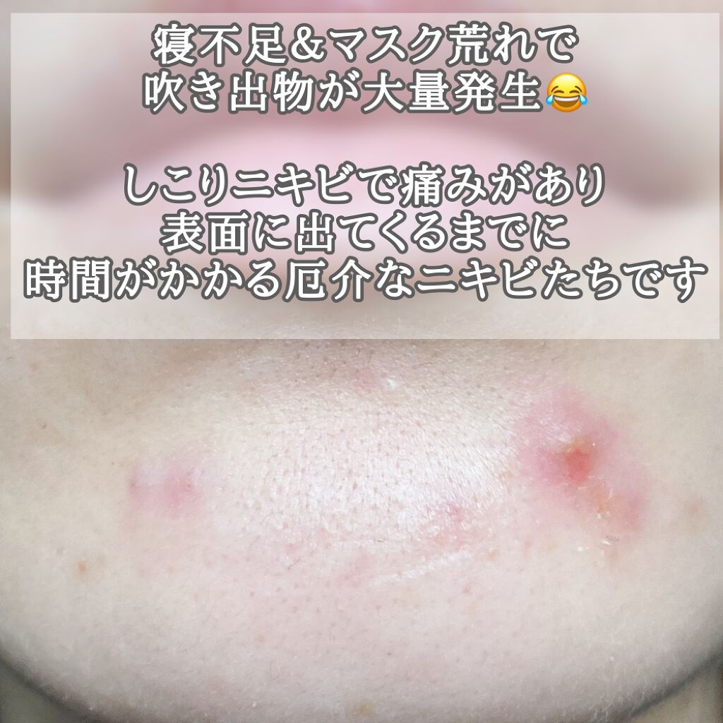 マキロン アクネージュ メディカルローション (医薬品)/マキロン/その他を使ったクチコミ(3枚目)