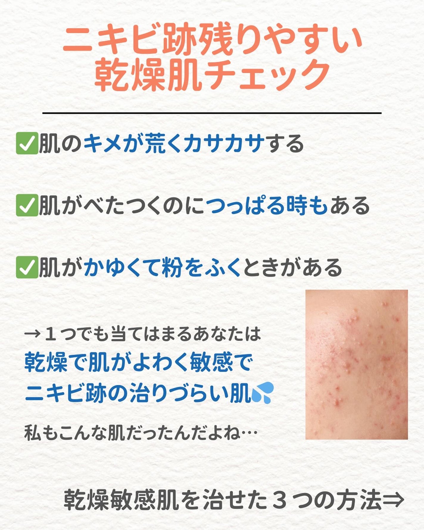 ニキビを諦めかけた人の味方|エマ🫧 on LIPS 「【始めましてのあなたへ✨】「私は一緒肌治らないのかな…」と過去..」(4枚目)