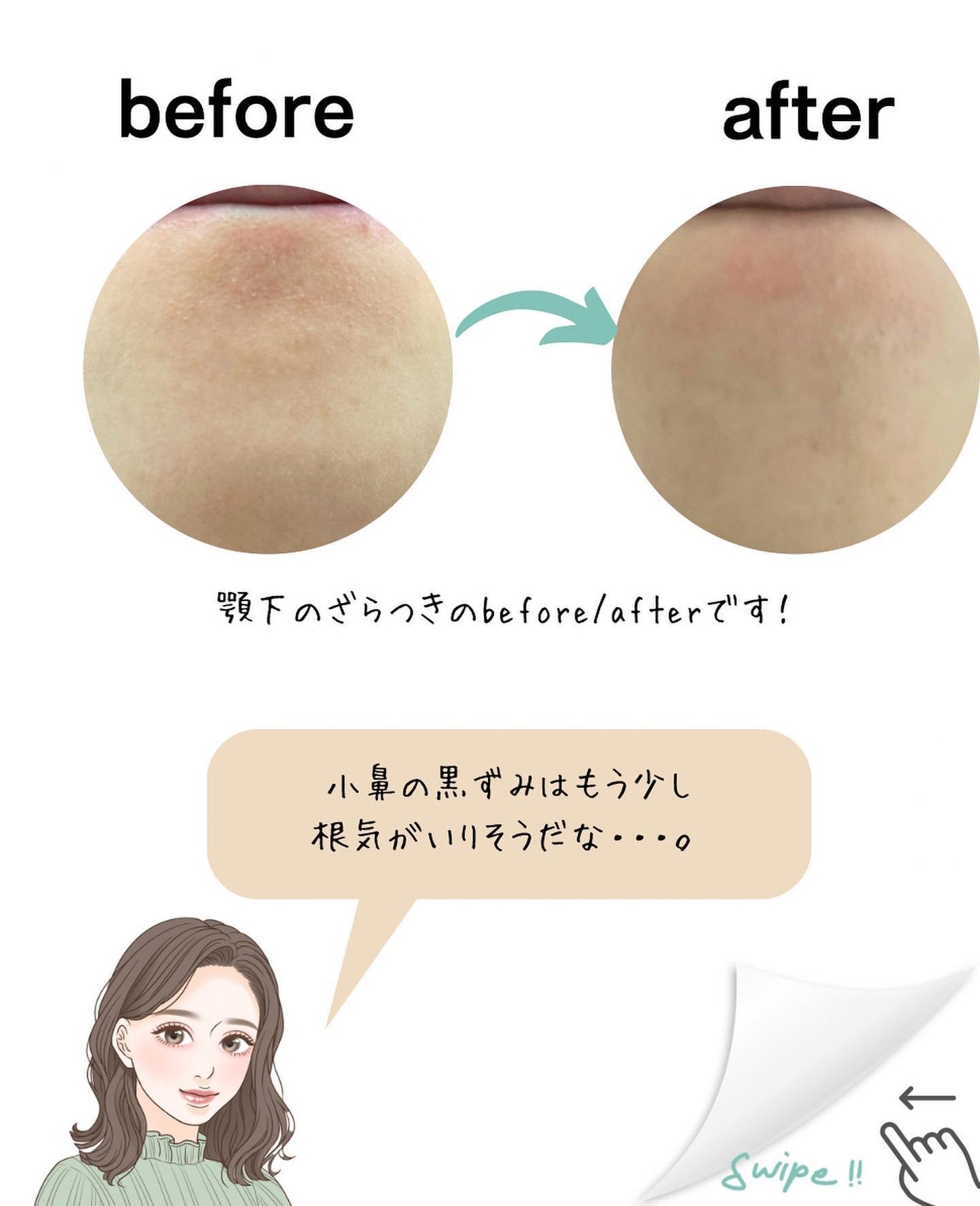 チョコブラ スペシャル毛穴ケアセット/Chocobra/スキンケアキットを使ったクチコミ(5枚目)