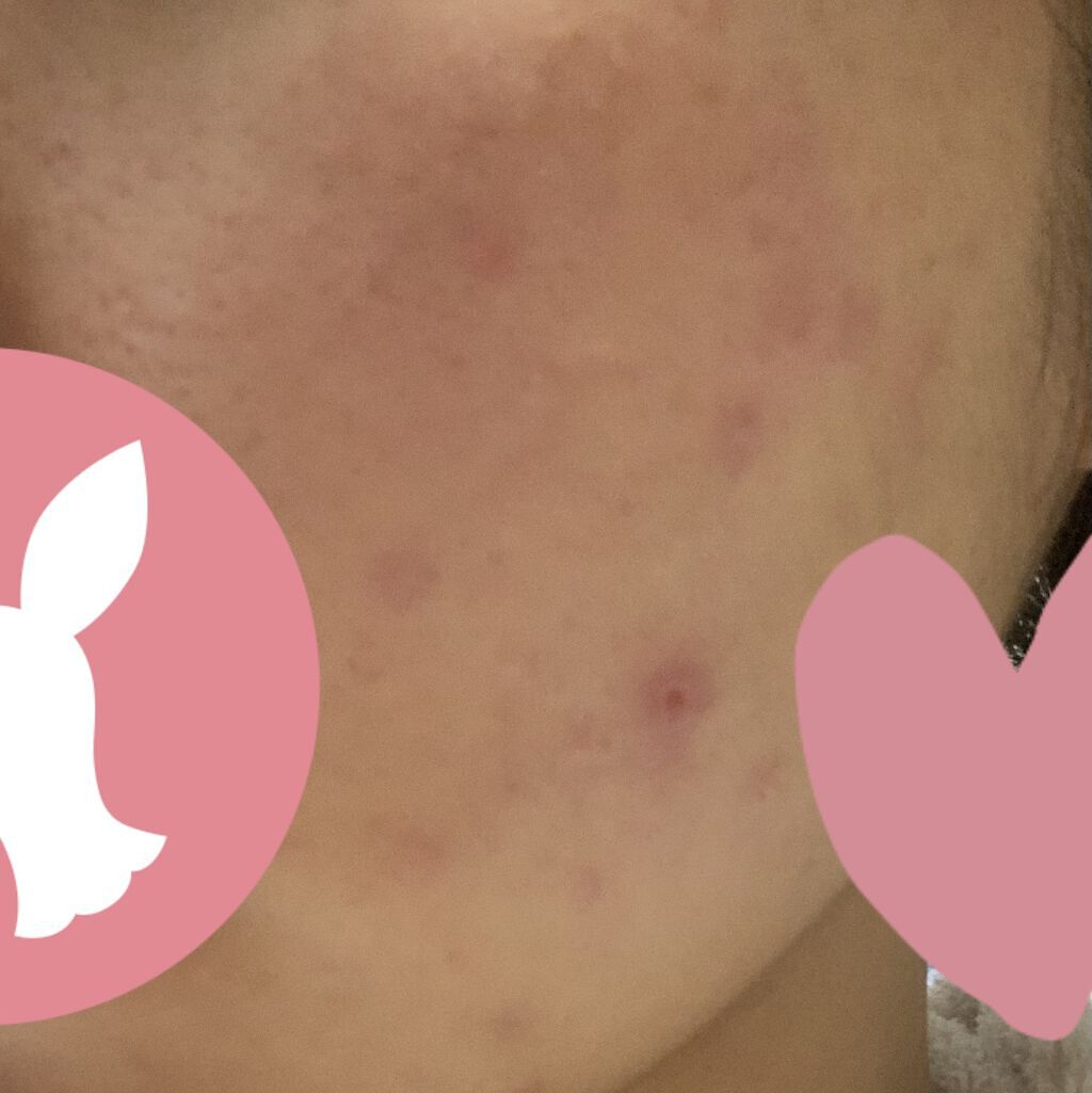 FDR アクネケア ジェル乳液/ファンケル/乳液を使ったクチコミ（2枚目）