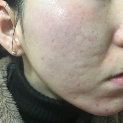 YEOUTH Glucolic Acid 30% Gel Peelのクチコミ「2/15の肌記録!
化粧水後の肌につき 毛穴目立ち辛い😅
「開き毛穴」 は化粧水だいじで.....」(1枚目)