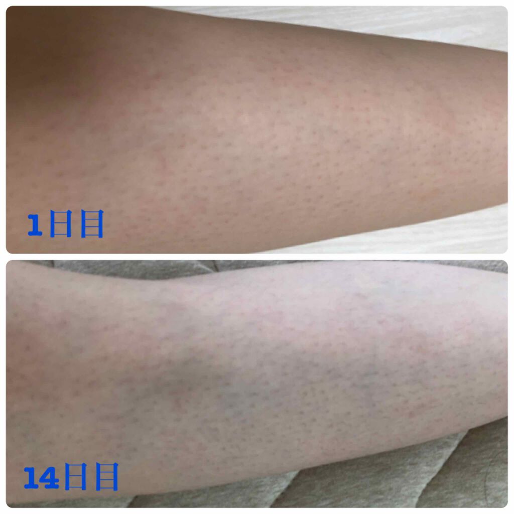 光美容器KE-NON（ケノン）/エムテック/家庭用脱毛器を使ったクチコミ（2枚目）