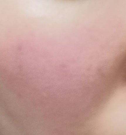 メディカルクリームc(医薬品)/メンソレータム アクネス25/その他を使ったクチコミ(3枚目)