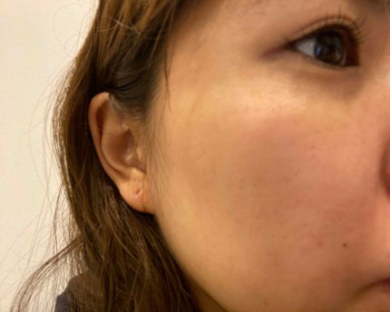 薬用顔ローション/ヘパソフト/化粧水を使ったクチコミ(2枚目)