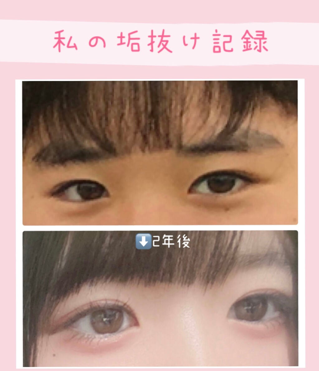 光美容器KE-NON(ケノン)/エムテック/家庭用脱毛器を使ったクチコミ(1枚目)