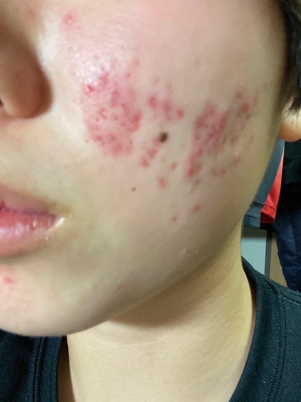 のの on LIPS 「約3週間が経過致しました。膿のあるニキビが減ってきていますがま..」(1枚目)