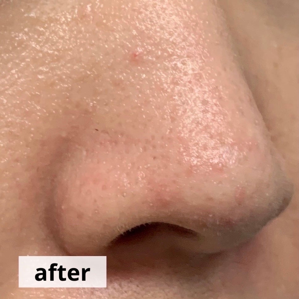 アンチポアブラックヘッドパーフェクトクリアキット/CNP Laboratory/シートマスク・パックを使ったクチコミ(6枚目)