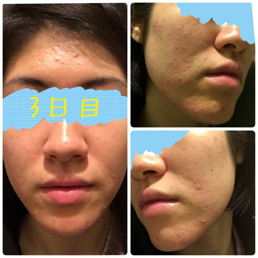 ベピオゲル/マルホ株式会社/その他を使ったクチコミ（2枚目）