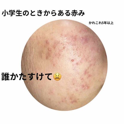 薬用 しみ 集中対策 美容液/メラノCC/美容液を使ったクチコミ(1枚目)