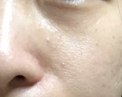 薬用 しみ 集中対策 美容液/メラノCC/美容液を使ったクチコミ(3枚目)