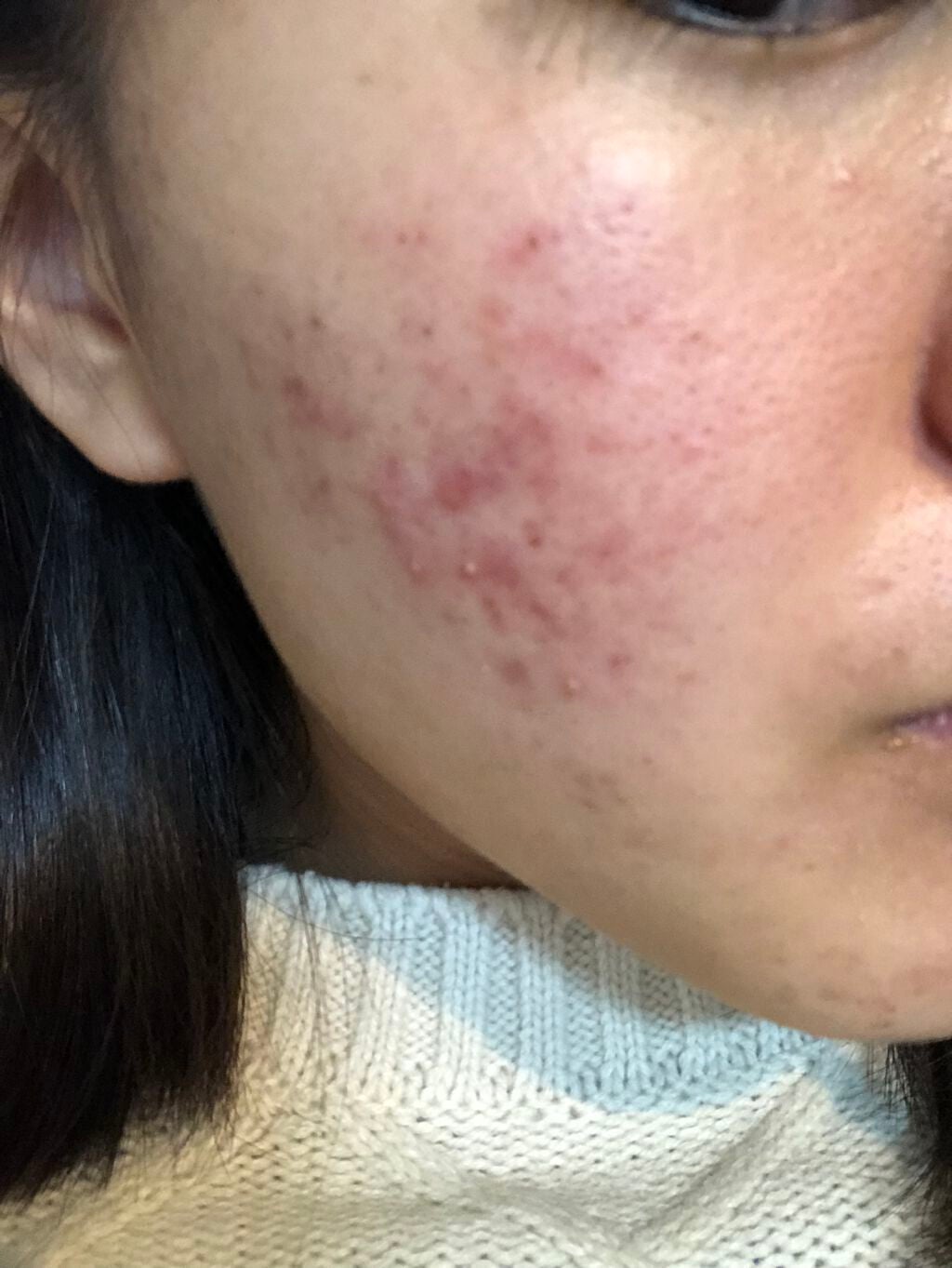 A アクネフォーム/NOV/洗顔フォームを使ったクチコミ(2枚目)