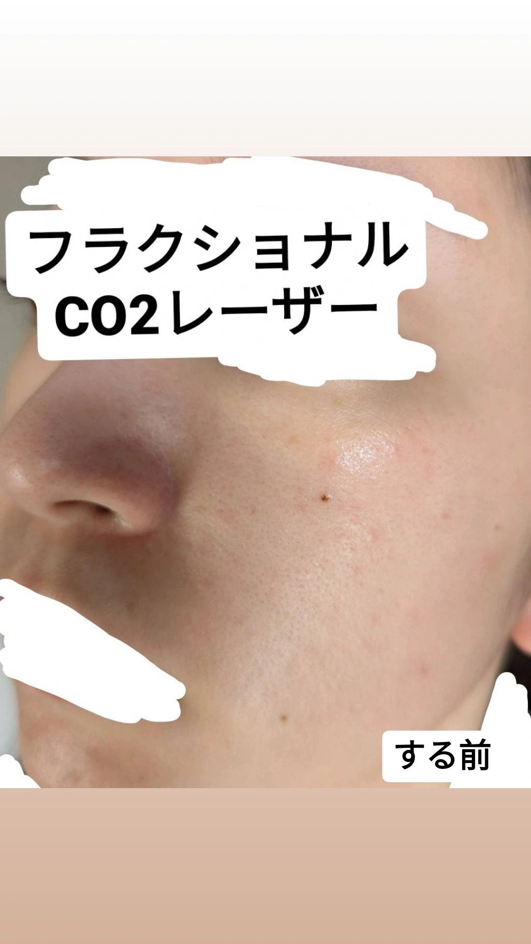 れれ on LIPS 「前情報:顔脱毛は1回しかまだ完了してません品川美容皮膚科でフラ..」(2枚目)