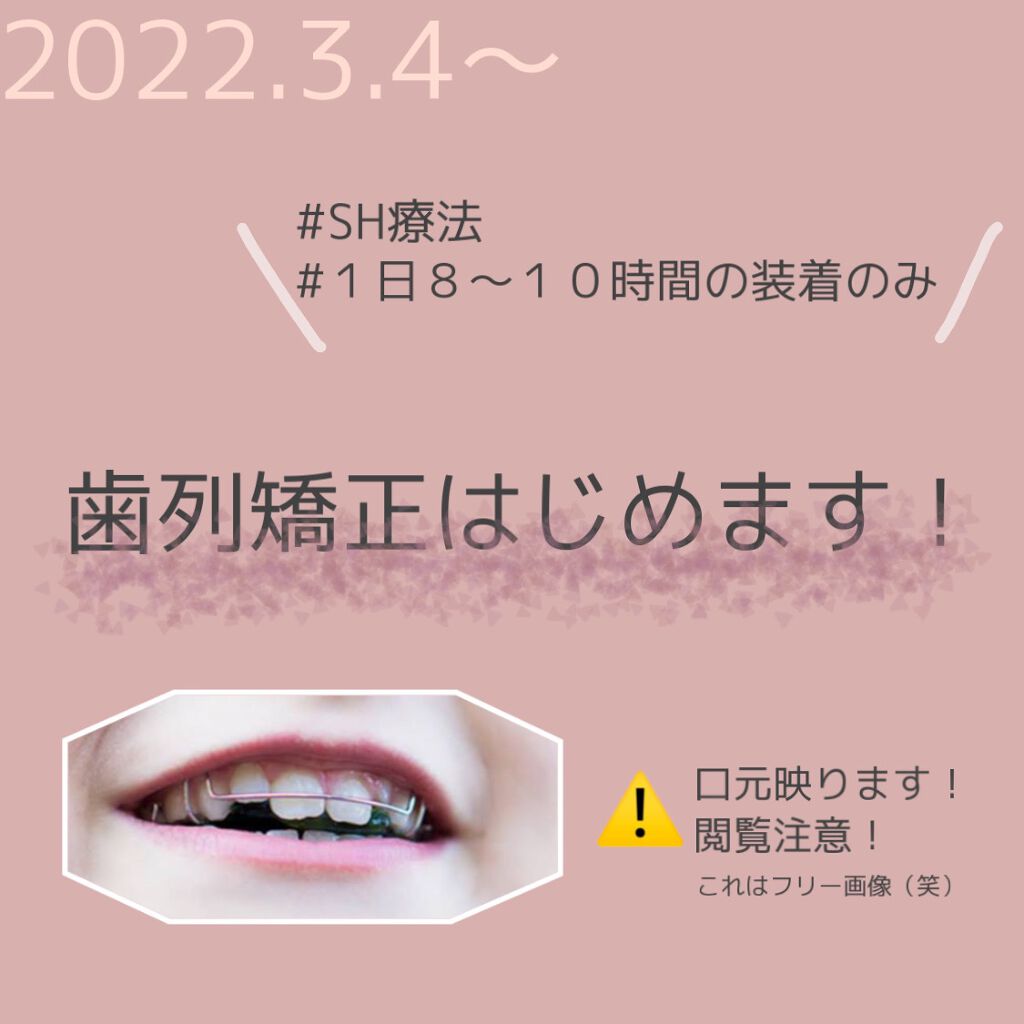 cokko on LIPS 「念願の歯列矯正始めます!ずっとしようしようと思って22歳にして..」(1枚目)