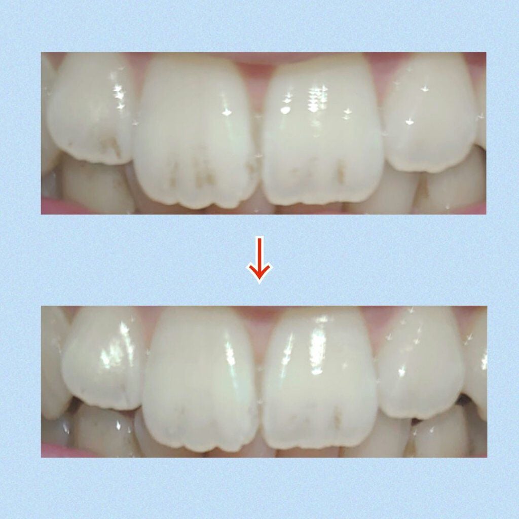 ホワイトニングスポンジ/キャンドゥ/その他オーラルケアを使ったクチコミ(4枚目)